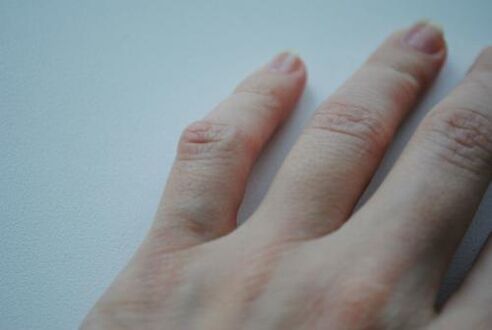 An arthritic lump has developed on the little finger. 