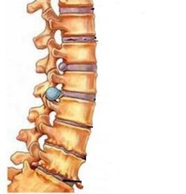 How osteochondrosis develops in the cervical region